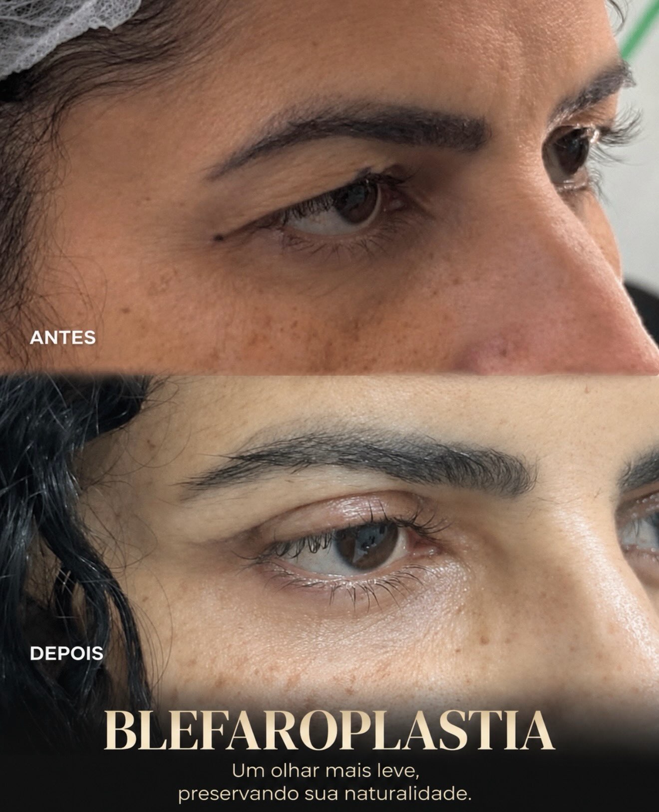 Comparativo em vista oblíqua da região dos olhos publicado pela Dra. Luma Reis.