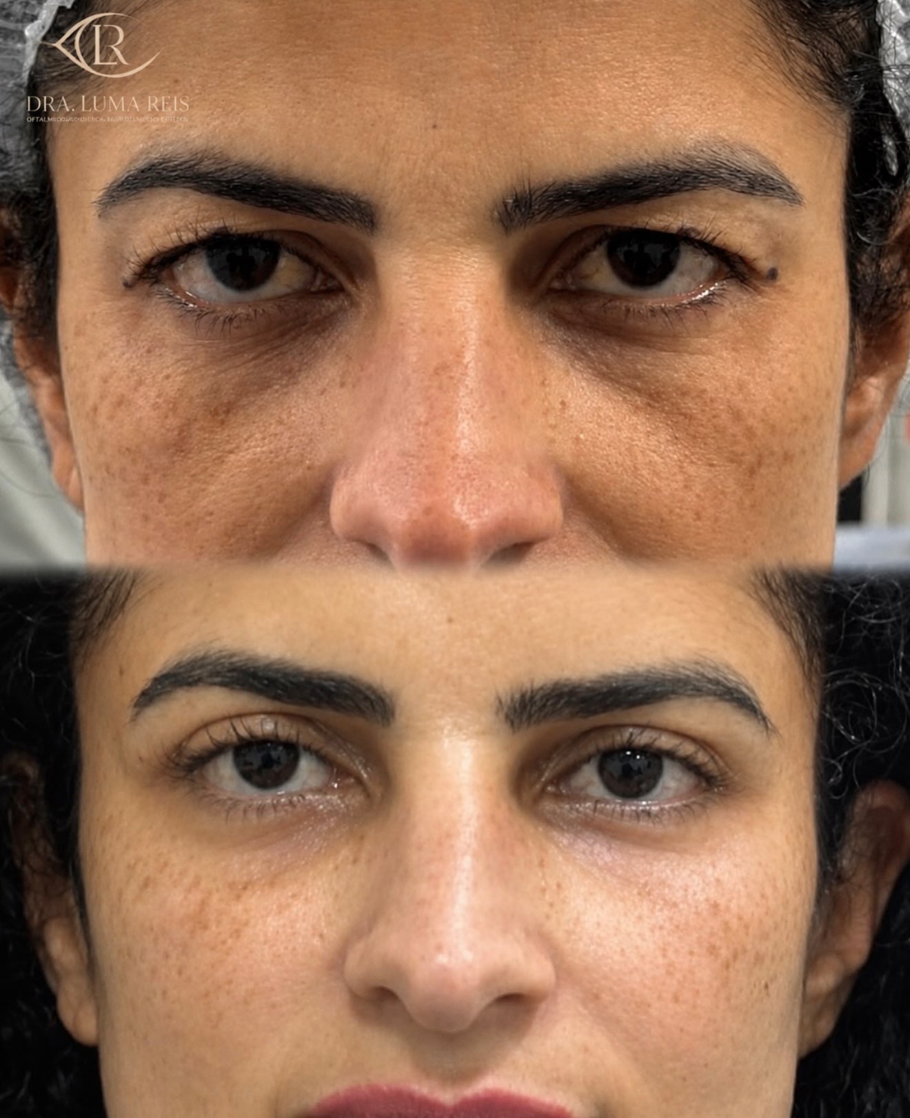 Comparativo frontal da região das pálpebras publicado pela Dra. Luma Reis.